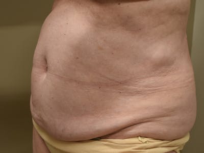 Tummy Tuck Before & After Gallery - Patient 105475 - Image 1
