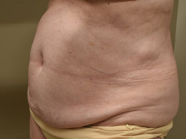 Tummy Tuck Before & After Gallery - Patient 105475 - Image 1