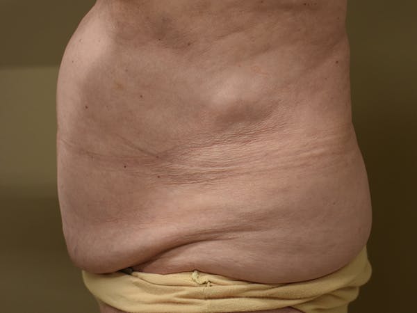 Tummy Tuck Before & After Gallery - Patient 105475 - Image 3