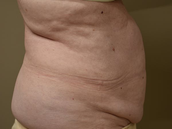 Tummy Tuck Before & After Gallery - Patient 105475 - Image 5