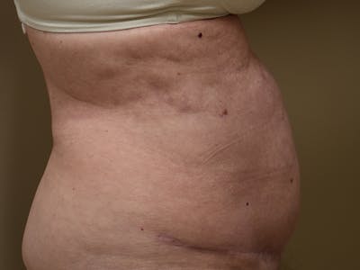 Tummy Tuck Before & After Gallery - Patient 105475 - Image 6