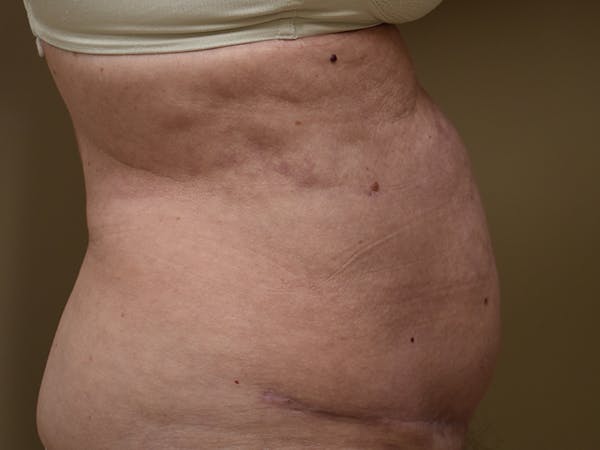 Tummy Tuck Before & After Gallery - Patient 105475 - Image 6