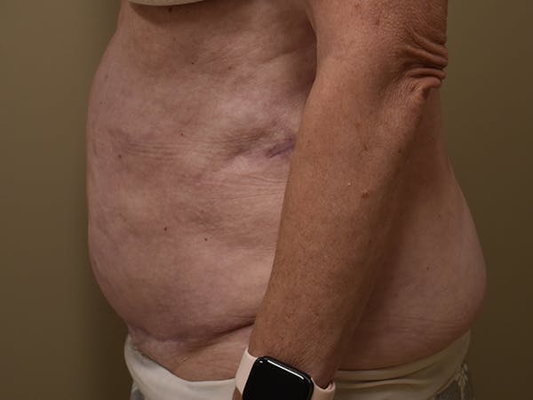 Tummy Tuck Before & After Gallery - Patient 105475 - Image 4