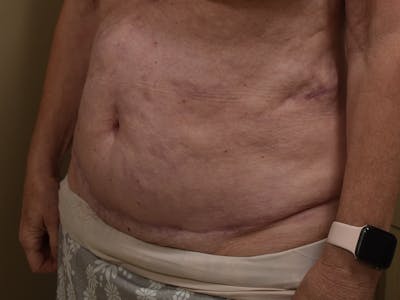 Tummy Tuck Before & After Gallery - Patient 105475 - Image 2