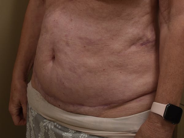 Tummy Tuck Before & After Gallery - Patient 105475 - Image 2