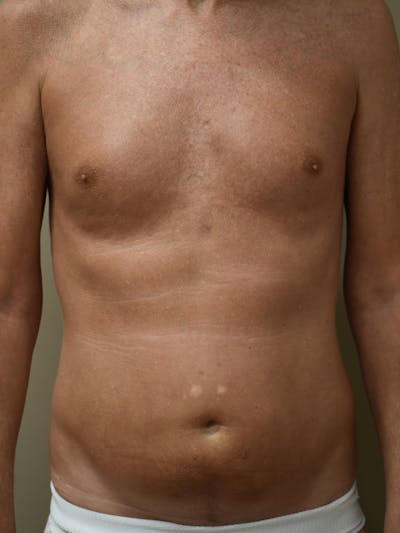 Liposuction Before & After Gallery - Patient 280999 - Image 1
