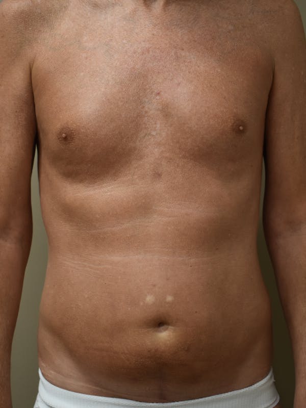 Liposuction Before & After Gallery - Patient 280999 - Image 1
