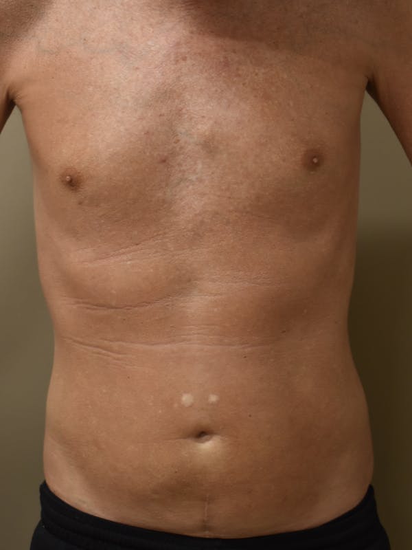 Liposuction Before & After Gallery - Patient 280999 - Image 2