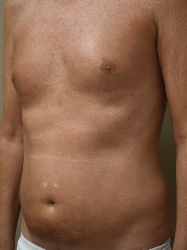 Liposuction Before & After Gallery - Patient 280999 - Image 3