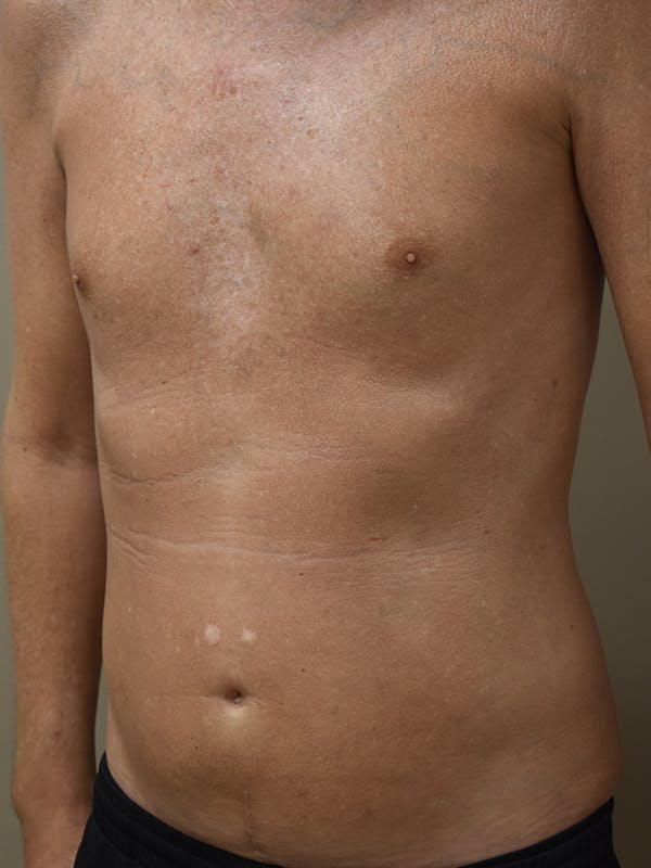 Liposuction Before & After Gallery - Patient 280999 - Image 4
