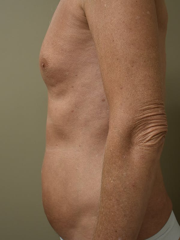 Liposuction Before & After Gallery - Patient 280999 - Image 5