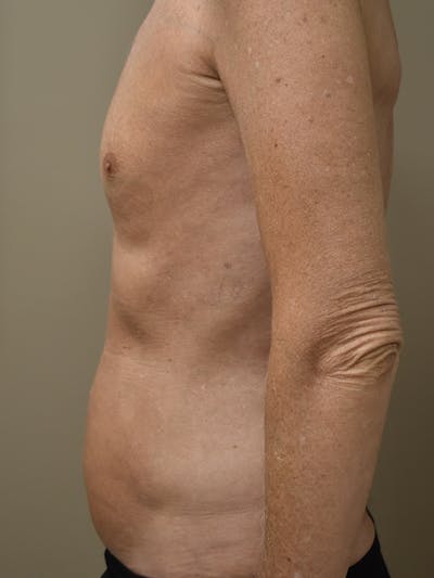 Liposuction Before & After Gallery - Patient 280999 - Image 6