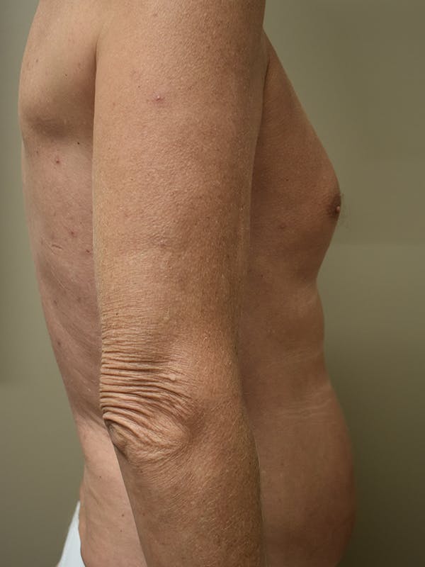 Liposuction Before & After Gallery - Patient 280999 - Image 7