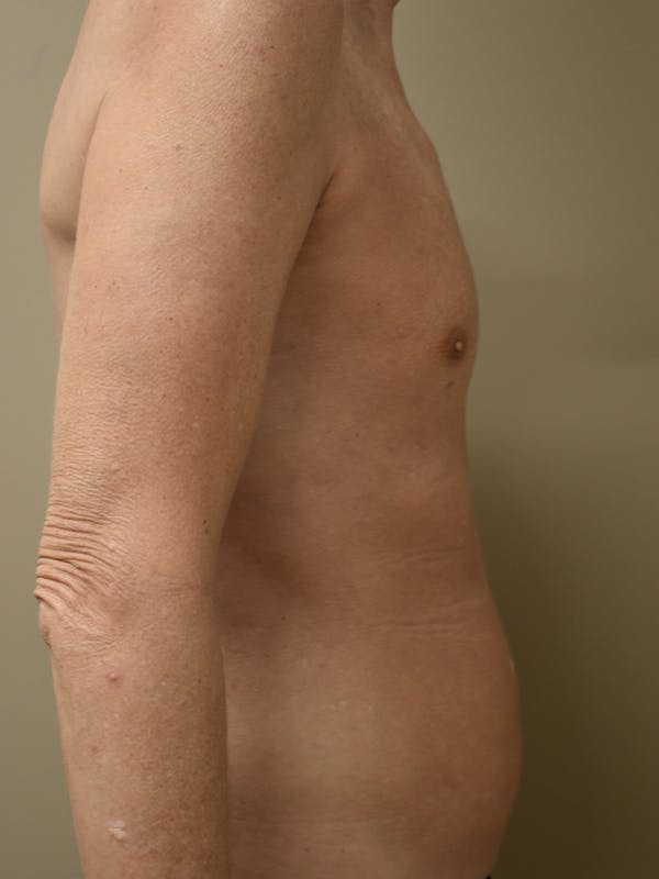 Liposuction Before & After Gallery - Patient 280999 - Image 8