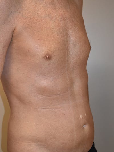 Liposuction Before & After Gallery - Patient 280999 - Image 10