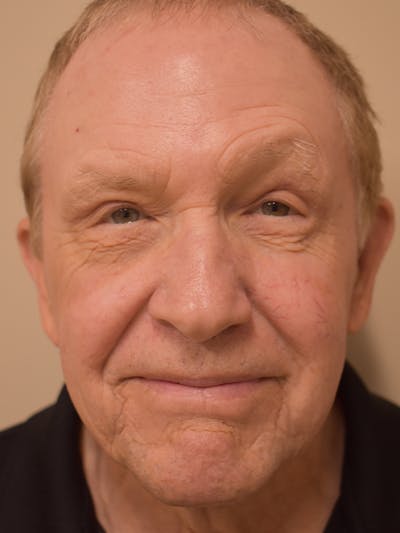 Eyelid Surgery Before & After Gallery - Patient 156085 - Image 2