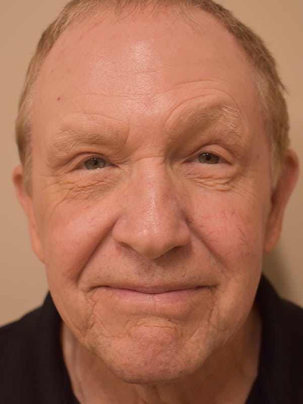 Eyelid Surgery Before & After Gallery - Patient 156085 - Image 2
