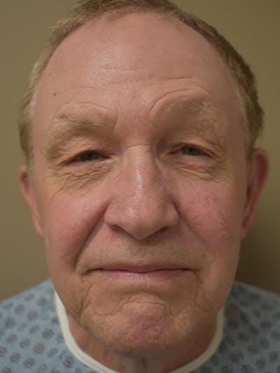 Eyelid Surgery Before & After Gallery - Patient 156085 - Image 1