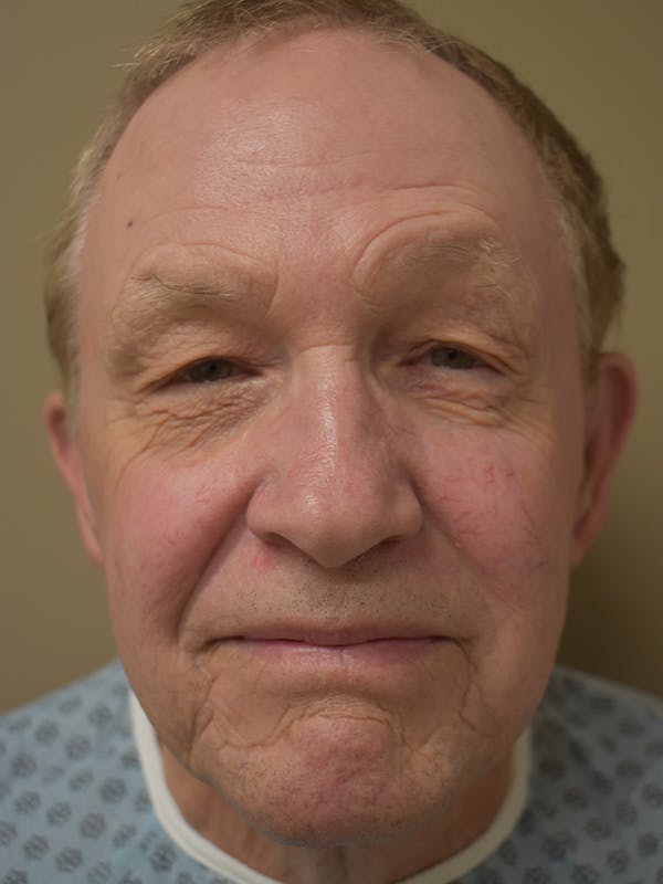 Eyelid Surgery Before & After Gallery - Patient 156085 - Image 1