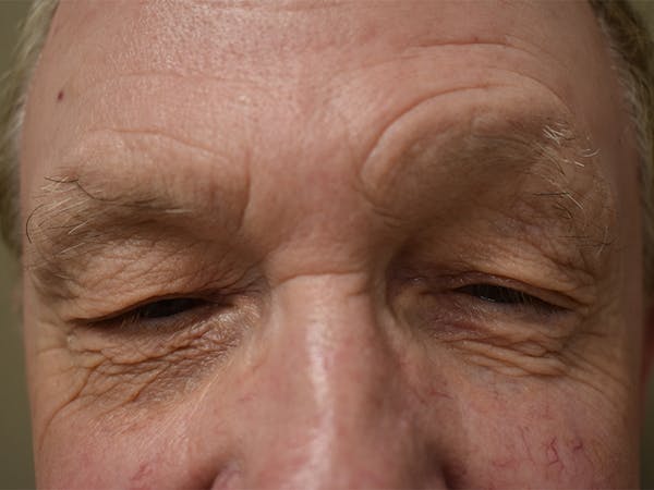 Eyelid Surgery Before & After Gallery - Patient 156085 - Image 3