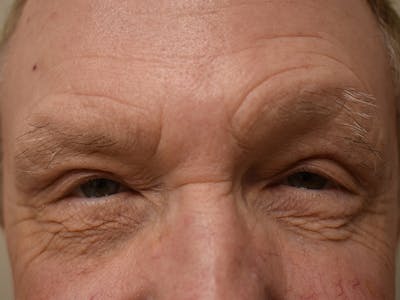 Eyelid Surgery Before & After Gallery - Patient 156085 - Image 4