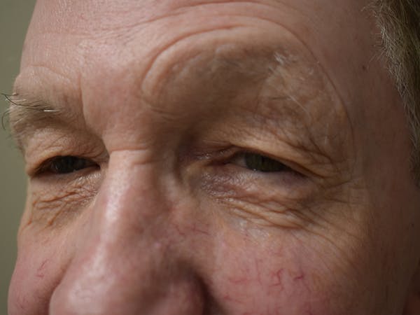 Eyelid Surgery Before & After Gallery - Patient 156085 - Image 5