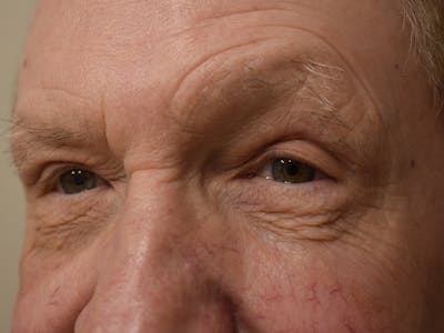 Eyelid Surgery Before & After Gallery - Patient 156085 - Image 6