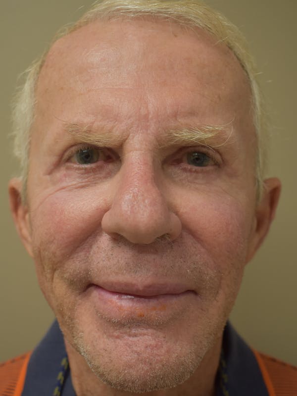 Eyelid Surgery Before & After Gallery - Patient 299317 - Image 2
