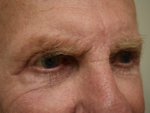 Eyelid Surgery Before & After Gallery - Patient 299317 - Image 3