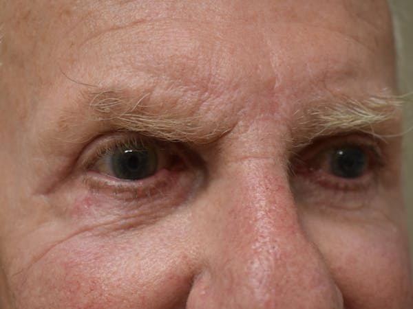 Eyelid Surgery Before & After Gallery - Patient 299317 - Image 4