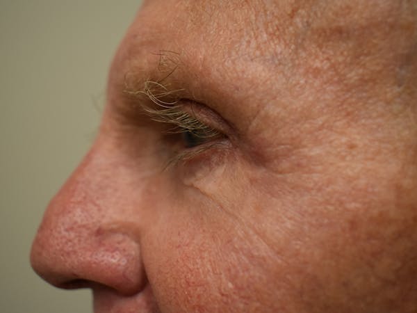 Eyelid Surgery Before & After Gallery - Patient 299317 - Image 5