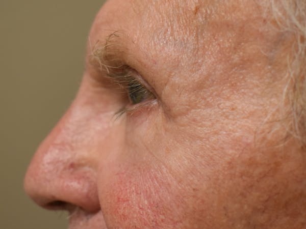 Eyelid Surgery Before & After Gallery - Patient 299317 - Image 6