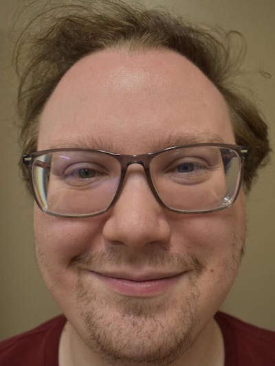 Hair Restoration Before & After Gallery - Patient 112765 - Image 1