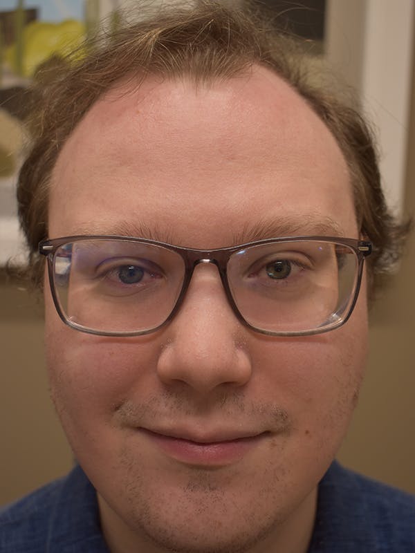 Hair Restoration Before & After Gallery - Patient 112765 - Image 2