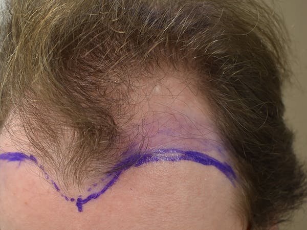 Hair Restoration Before & After Gallery - Patient 112765 - Image 3