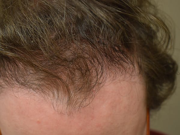 Hair Restoration Before & After Gallery - Patient 112765 - Image 4