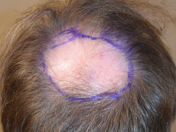 Hair Restoration Before & After Gallery - Patient 112765 - Image 5