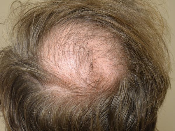 Hair Restoration Before & After Gallery - Patient 112765 - Image 6