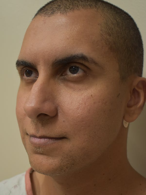Chin Augmentation Before & After Gallery - Patient 329229 - Image 3