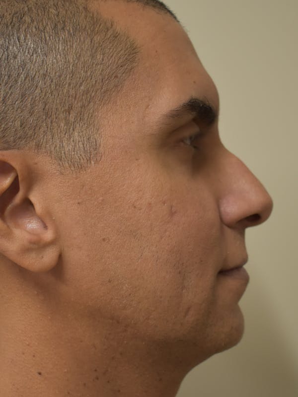 Chin Augmentation Before & After Gallery - Patient 329229 - Image 5