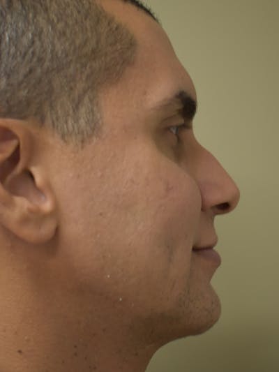 Chin Augmentation Before & After Gallery - Patient 329229 - Image 6