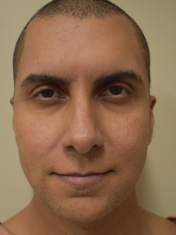 Chin Augmentation Before & After Gallery - Patient 329229 - Image 1