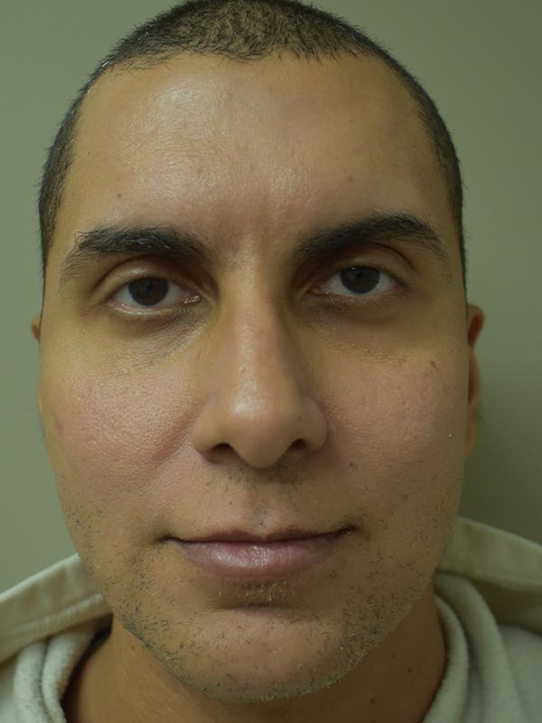 Chin Augmentation Before & After Gallery - Patient 329229 - Image 2