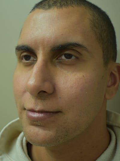 Chin Augmentation Before & After Gallery - Patient 329229 - Image 4