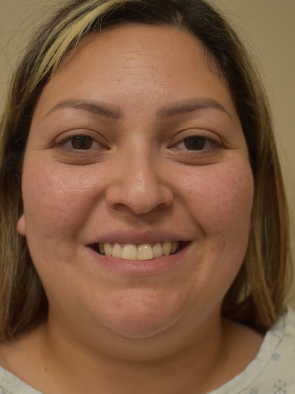 Submental Liposuction Before & After Gallery - Patient 327492 - Image 3