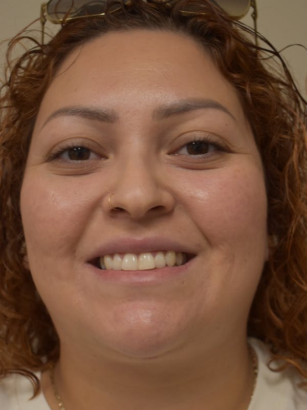 Submental Liposuction Before & After Gallery - Patient 327492 - Image 4