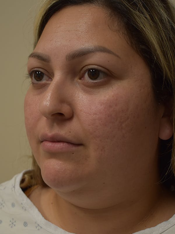 Submental Liposuction Before & After Gallery - Patient 327492 - Image 5