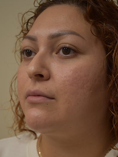 Submental Liposuction Before & After Gallery - Patient 327492 - Image 6