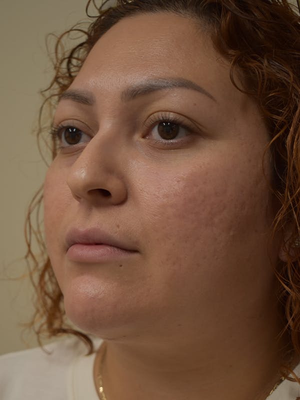 Submental Liposuction Before & After Gallery - Patient 327492 - Image 6