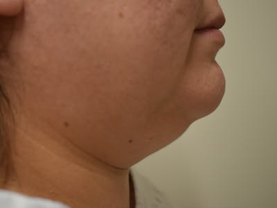 Submental Liposuction Before & After Gallery - Patient 327492 - Image 1